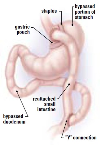 Roux-en-Y Gastric Bypass